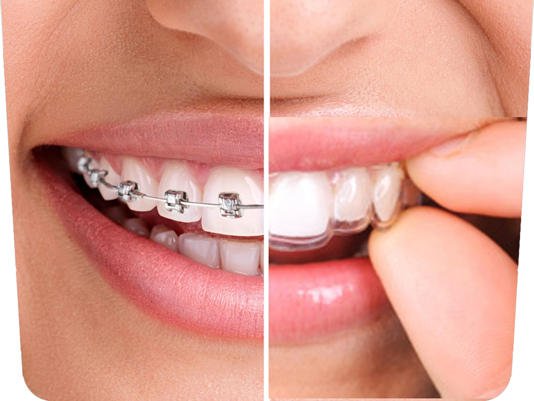 ¿Braquets invisibles o Invisalign?