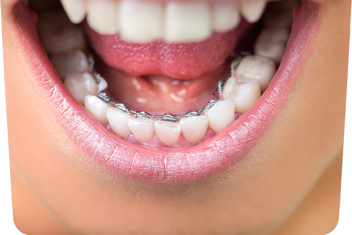 Ortodoncia Lingual: ¿Vamos de incógnito?