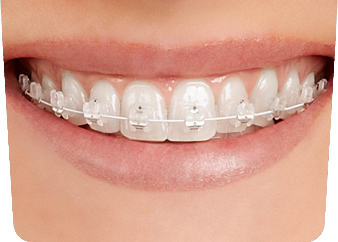 Braquets invisibles